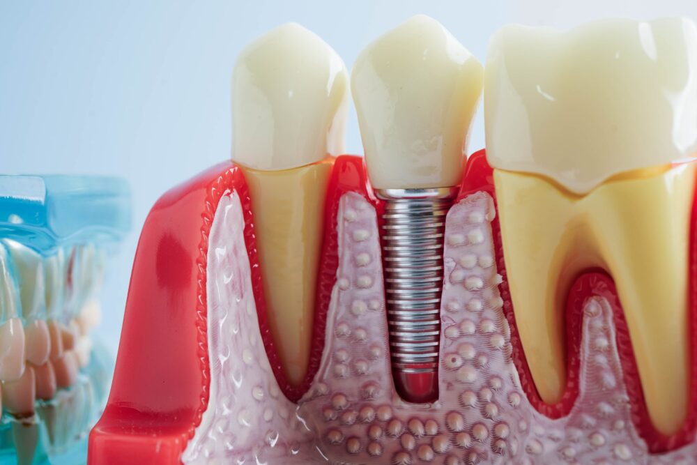 dental implants Richardson